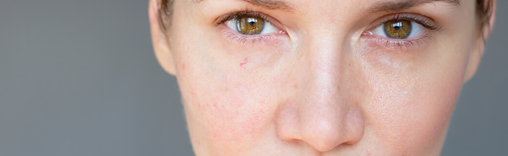 Lasersko odstranjevanje razširjenih kapilar